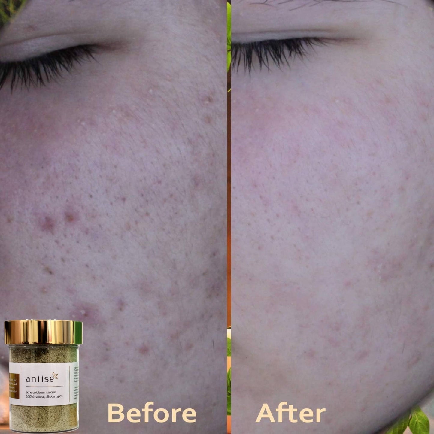 Acne Solution Kit for Face - Trending Wellness Store