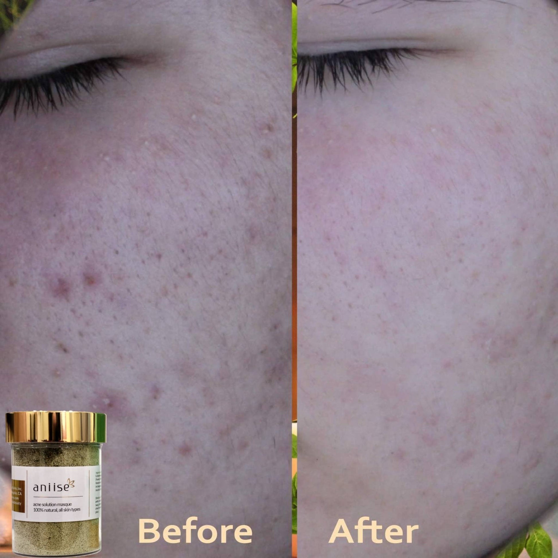 Acne Solution Kit for Face - Trending Wellness Store