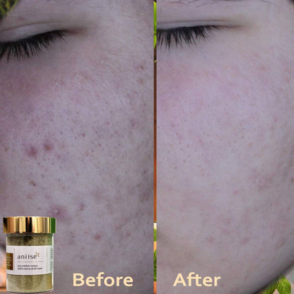 Acne Solution Kit for Face - Trending Wellness Store