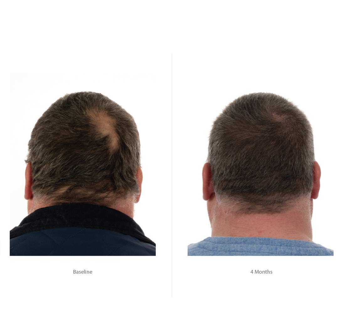 FOLIGAIN® Triple Action Conditioner For Thinning Hair For Men with 2% TRIOXIDIL® 473ml